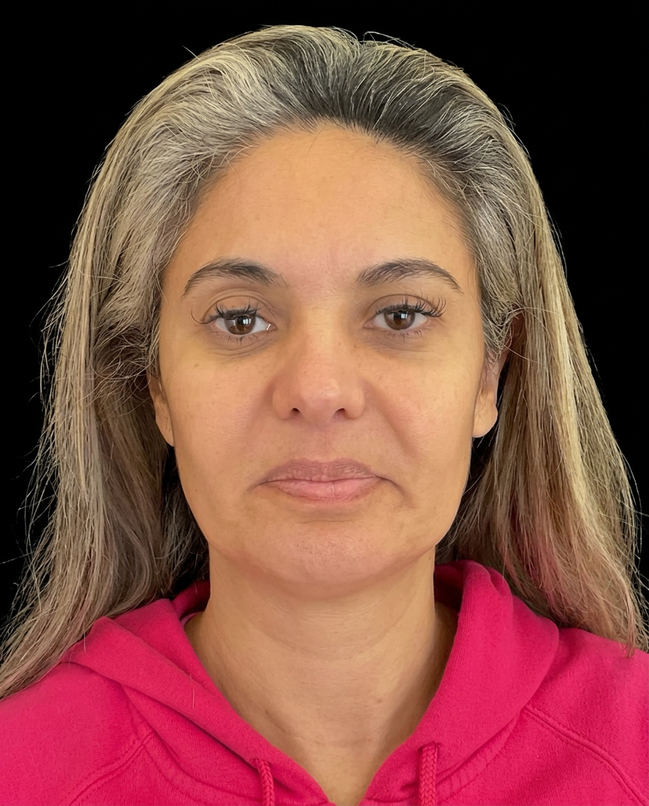 Antes do procedimento de Preenchimento Labial